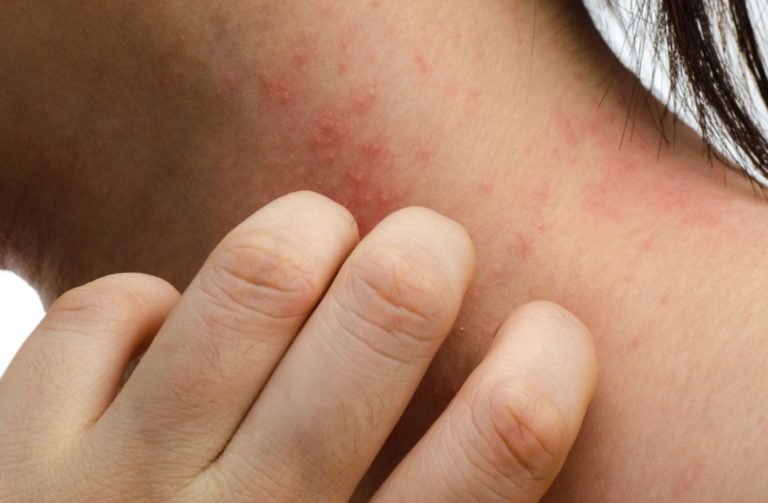 Complicaciones producidas por el Herpes Zóster