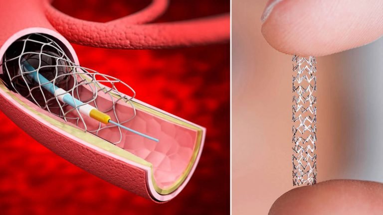 ANGIOPLASTIA Y COLOCACIÓN DE STENT EN EL CORAZÓN